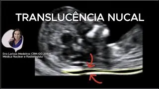 TRANSLUCÊNCIA NUCAL  -  Ultrassom obstétrico