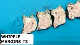 Whipple’s specimen (pancreaticoduodenectomy) margins. Part 3