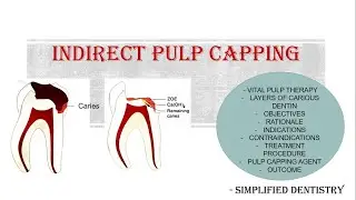 Indirect Pulp Capping