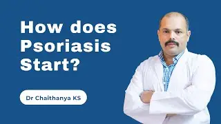 How does psoriasis start?  Main causes, symptoms, triggers of psoriasis.