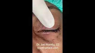 Laser Lower Eyelid Blepharoplasty by Dr. Joe Niamtu, III   