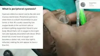 Peripheral Cyanosis // Practical viva // Clinical