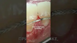 Как правильно ухаживать за зубами с ретейнером?