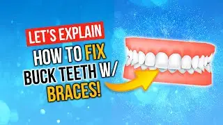 How Long Does It Take To Treat A MINOR OVERBITE?!