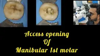 Access opening of manibular 1st molar # step by step rootcanal treatment#rct  for beginners