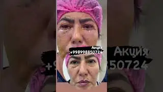 Блефаропластика Нижних Век после процедуры сразу  пастки ковок пластикаси 100$ +998998850724 ￼