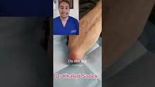 Cyst on the elbow