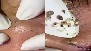 Best Oddly Satisfying Video Mengeluarkan Jerawat yang Sudah Banyak