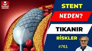 761. Stent neden tıkanır? Tıkanma Riskler, Prof.Dr.Serdar Akgün, Aktüel Sağlık