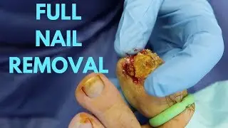 FULL BIG NAIL REMOVAL! **MUST SEE**