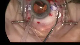 Glued Intraocular Lens Fixation