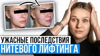 Вы НЕ ОЖИДАЕТЕ этого от НИТЕВОГО ЛИФТИНГА! / Страшные ПОСЛЕДСТВИЯ подтяжки лица НИТЯМИ