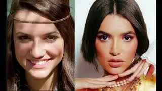 Antes e Depois BBB 20 - Cirurgia Plastica e Harmonização Facial