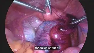 Copy of COR 432 092024 Ovarian torsion