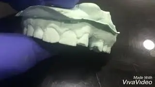Maryland Bridge Using Fibre Splint