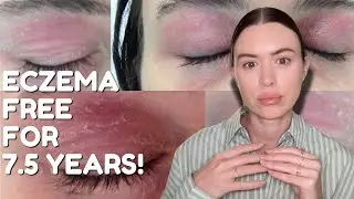 3 TIPS FOR HOW I CURED MY ECZEMA FOR 7.5 YEARS!