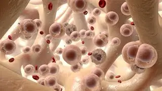 Entendiendo la leucemia