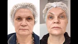 Индивидуальная программа омоложения