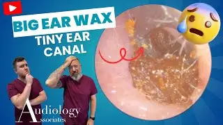 Epic Ear Wax Extraction: David vs. Goliath (Tiny Canal Edition!) - EP1093