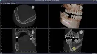 IDIXEL et IMPLANTOLOGIE