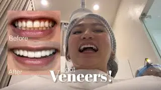 NEW SET OF TEETH | Zirconia-reinforced composite veneers + how much? | Natural looking veneers