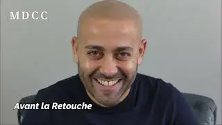 Kamel, sa retouche 3 ans et demi après sa Micropigmentation des Cheveux