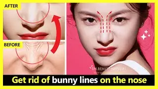 Just 4 minutes! How to get rid of bunny lines on the nose, nose wrinkles naturally.