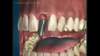 Имплантация