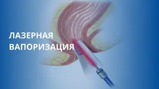 Лазерная вапоризация