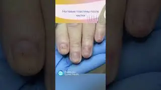 Грибок ногтей #подология #дерматология #дерматолог #грибокногтей #грибок #лечениеногтей #ногти
