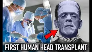 First (Successful???) Human Head Transplant 2017  | Dr Sergio Canavero (a.k.a Frankenstein)