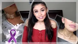 MI CICATRIZ DE LA CIRUGIA🦋 ASÍ VA MI CICATRIZ DESPUÉS DE LA CIRUGÍA DE CÁNCER🎗