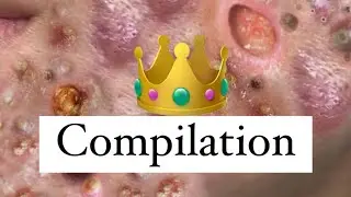 World's Greatest Medical Clips!   Blackhead King