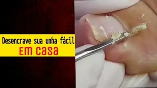 como desencravar unha  em casa