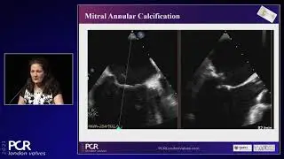 Transcatheter mitral valve replacement: patient selection and hemodynamic stability