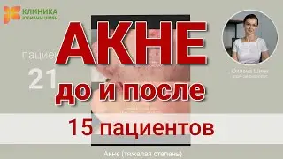 АКНЕ - До и после - 15 пациентов. Полное видео