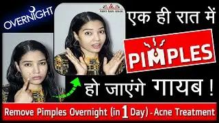 एक ही रात में Pimples हो जाएंगे गायब - Remove Pimples Overnight | in One Day | Acne Treatment-(2021)