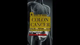 6 steps to prevent colon cancer