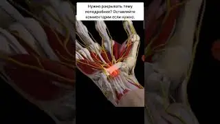Синдром запястного канала. Карпальный синдром.