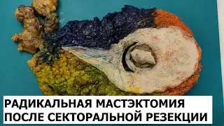Радикальная мастэктомия после секторальной резекции