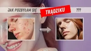 JAK POZBYŁAM SIĘ TRĄDZIKU | Codzienna pielęgnacja