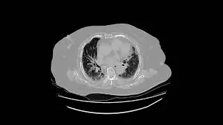 honeycomb lung