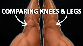 Comparing Knees & Legs 1 Year Post ACL Surgery