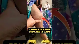 4th Stage Knee Arthritis 🔥#rheumatoidarthritis #rheumatoid_arthritis