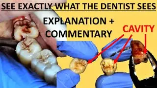 Upper and Lower Right Wisdom Tooth Removal (Extraction) - Full Surgery Walkthrough Sydney Australia