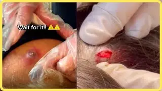 Pimple Popping Compilations Tik Tok Videos #내성발톱 #ASMR #blackheads  #blackhead #pimple #acne