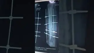 Infected tibia fracture management