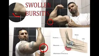 Swollen Burtitis My triceps so weak￼