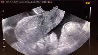 Embarazo ectopico roto. Hemoperitoneo.