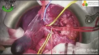 How I do it: Left hepatectomy in left lobe cholangiocarcinoma with clamp crushing(educational uncut)